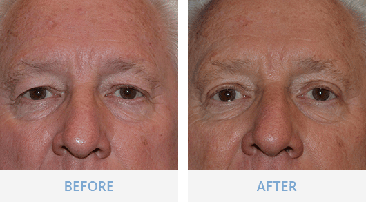 Eyelid surgery sales fort myers