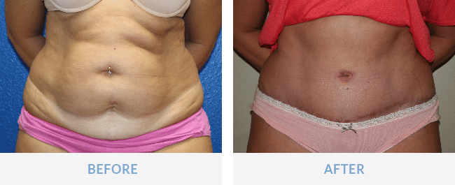 tummy tuck before and after fort myers fl