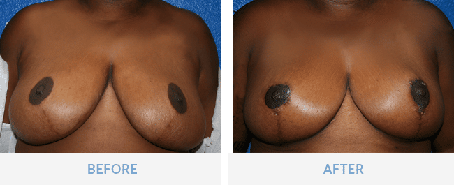 fort myers breast reduction