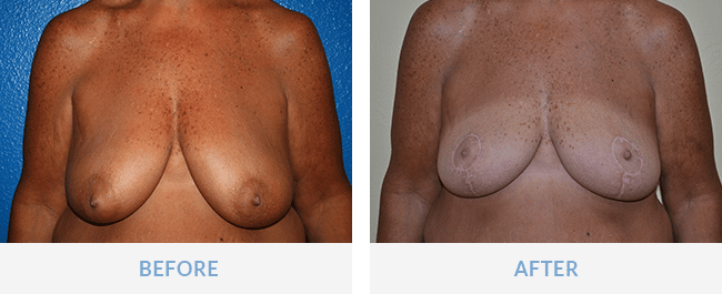 naples breast reduction before and after