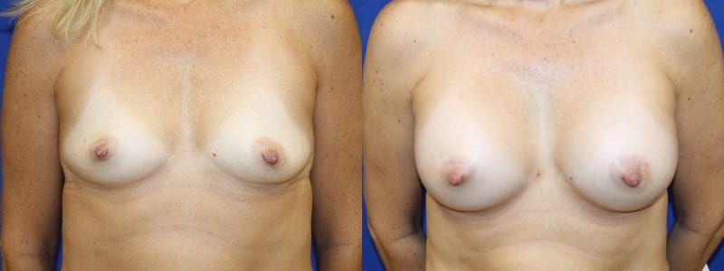before and after breast augmentation