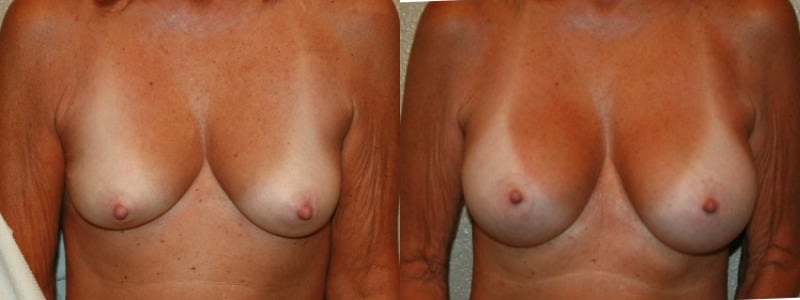 before and after breast augmentation with lift