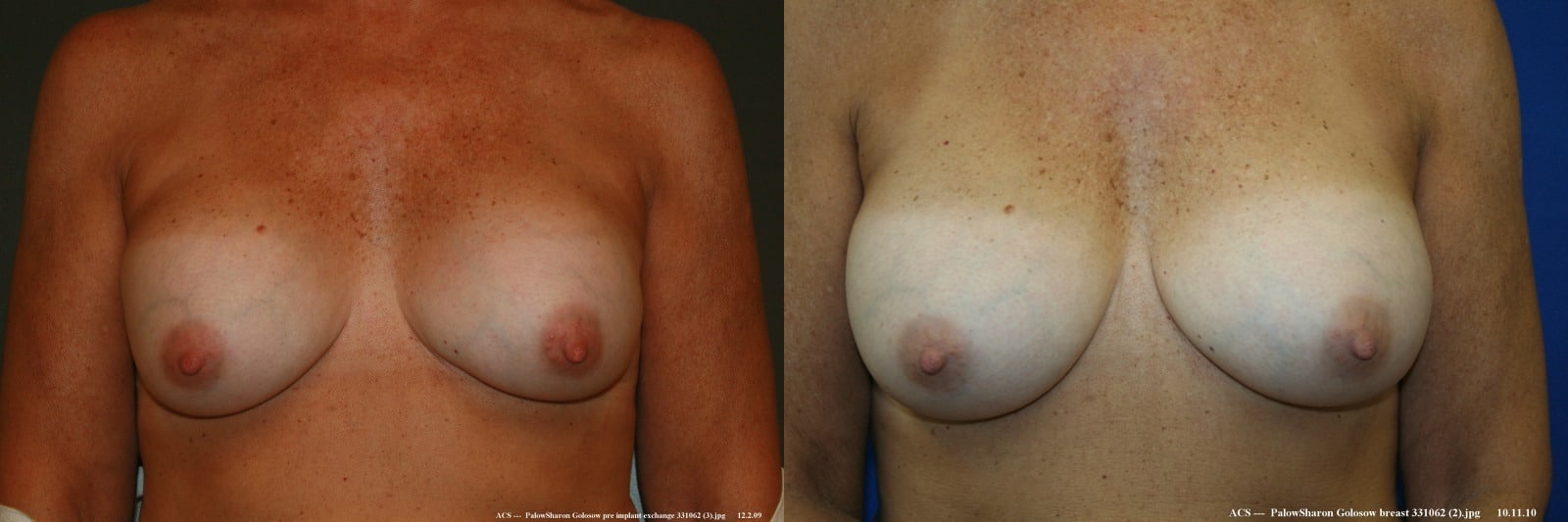 before and after breast implant exchange