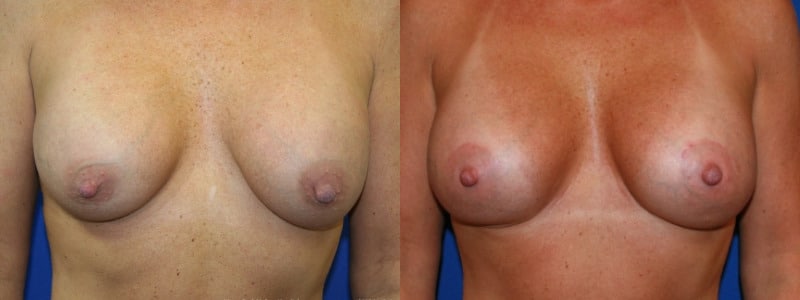 before and after breast implant exchange