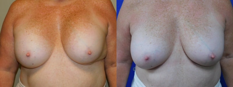before and after breast implant exchange