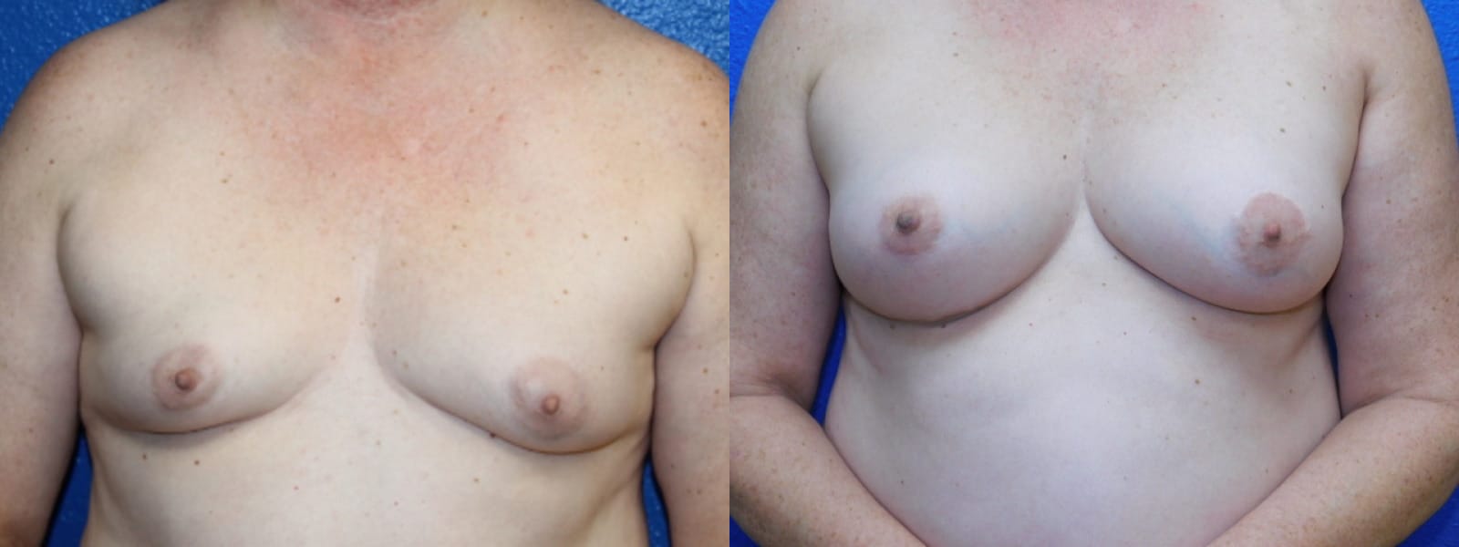 before and after breast augmentation with lift